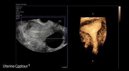 Samsung UterineControl