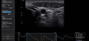 HS70A-arterial