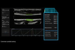 RS80EVO-arterialanalysis