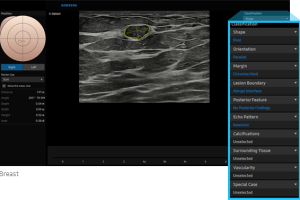 RS80EVO-sdetect-breast