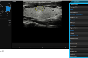 RS80EVO-sdetect-thyroid